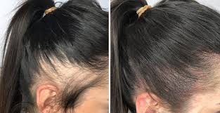 Scalp-Micropigmentation-7