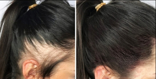 arizona-aesthetics-Scalp-Micropigmentation-10