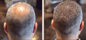 arizona-aesthetics-Scalp-Micropigmentation-13