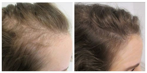 arizona-aesthetics-Scalp-Micropigmentation-18