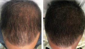 arizona-aesthetics-Scalp-Micropigmentation-2