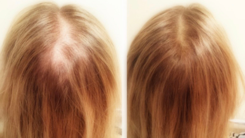 arizona-aesthetics-Scalp-Micropigmentation-7