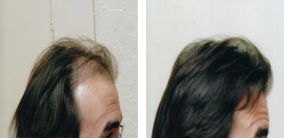 Hair Restoration Center in Palm Beach