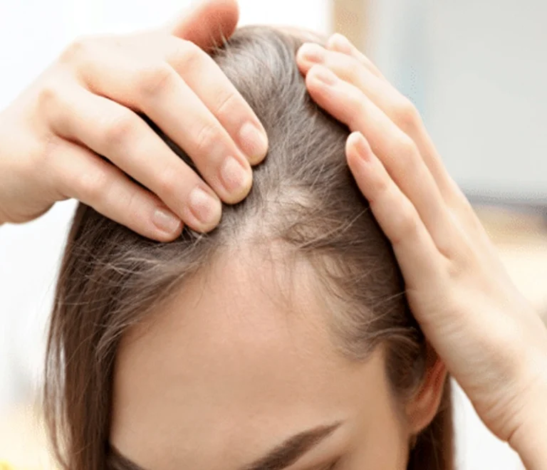 Understanding Stem Cell Therapy for Hair Loss