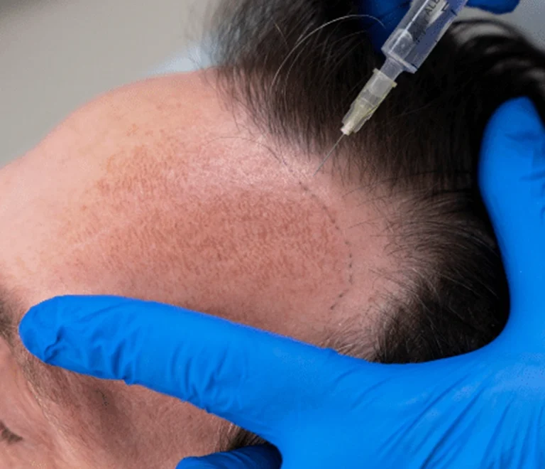 Stem Cell Hair Treatment vs. Traditional Hair Transplants 