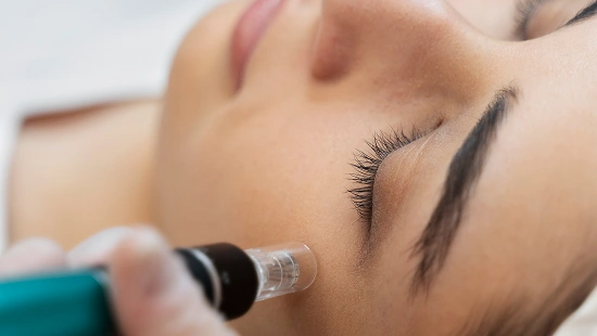 Microneedling