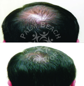 Men Hair Treatment_img1