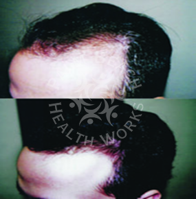 Men Hair Treatment_img10