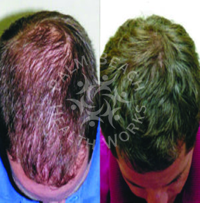 Men Hair Treatment_img12
