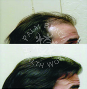 Men Hair Treatment_img2