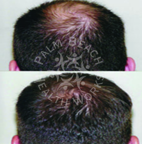Men Hair Treatment_img3