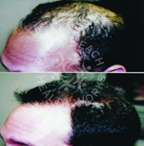 Men Hair Treatment_img4
