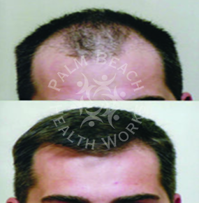 Men Hair Treatment_img6