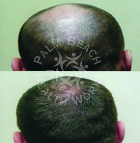 Men Hair Treatment_img8
