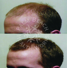 Men Hair Treatment_img9