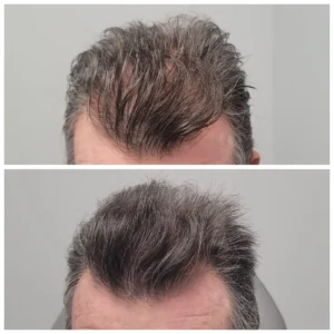 Men_Hair_Treatment_1