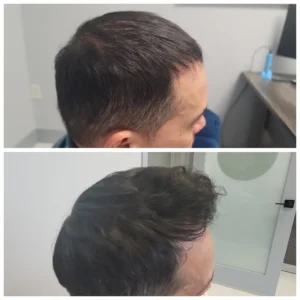 Men_Hair_Treatment_4