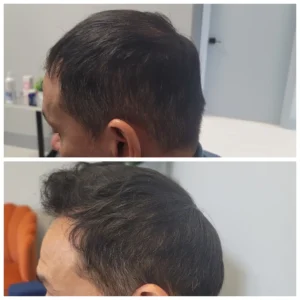 Mens_Hair_Treatment_2