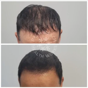 Stem Cells Hair Restoration Men _3