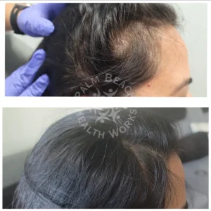Stem Cells Hair Restoration Men _4