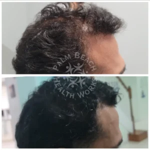Stem Cells Hair Restoration Men _6