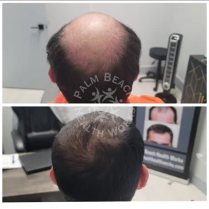 Stem Cells Hair Restoration Men_1