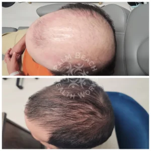 Stem Cells Hair Restoration Men_10