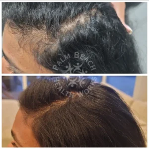 Stem Cells Hair Restoration Men_7