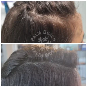 Stem Cells Hair Restoration Men_8