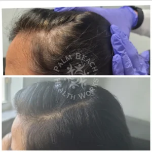 Stem Cells Hair Restoration _9