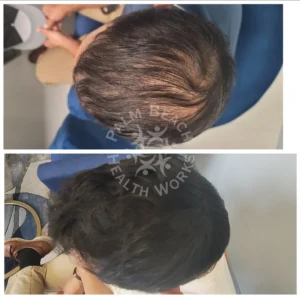 Stem Cells Hair Restoration men_2