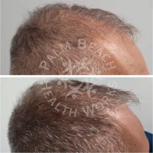 Hair Loss Gallary 3