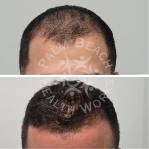 Hair Loss Gallary 4