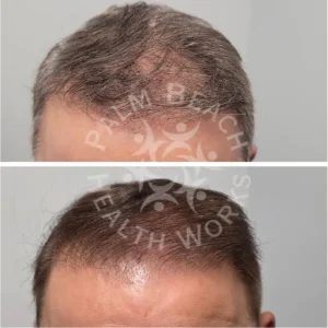 Hair Loss Gallary 5