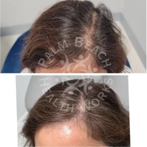 Womens Hair Loss