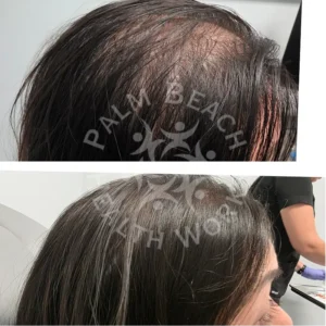 Womens Hair Loss