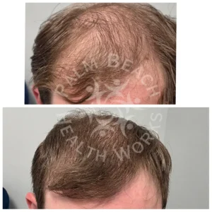 Before and After - Men