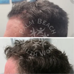 palm-beach-before-after-P1