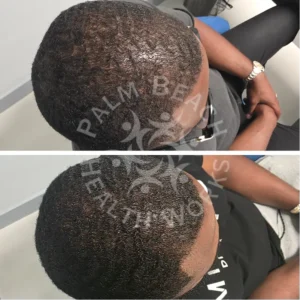 palm-beach-before-after-P10