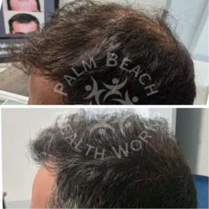 palm-beach-before-after-P3