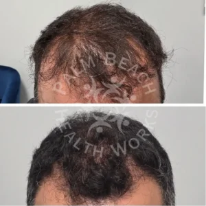 palm-beach-before-after-P4