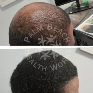 palm-beach-before-after-P6