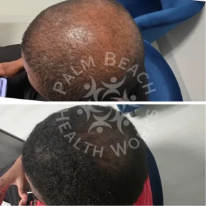 palm-beach-before-after-P8