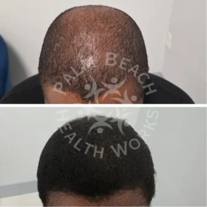 palm-beach-before-after-P9